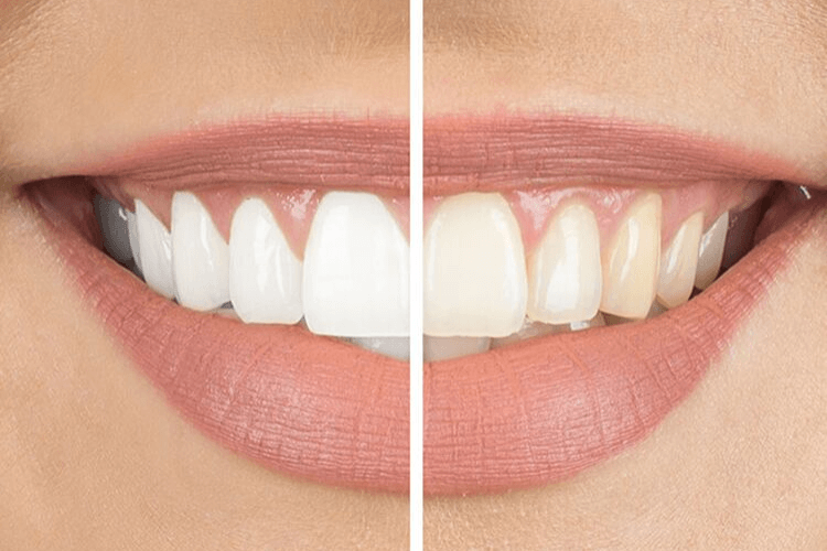 blanchiment-dentaire-avis blanchiment-dentaire-douleur